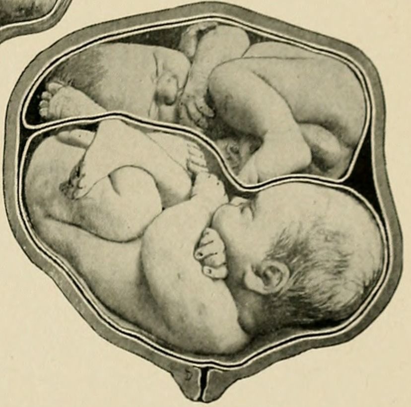 Dvojčata v děloze. Cameron a kol. 1903. The American text book of obstetrics for practitioners and students. Wikimedia Commons CC BY SA PD old